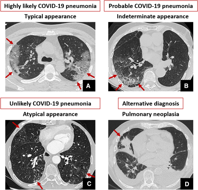 Chest CT in the emergency department for suspected COVID-19 pneumonia |  SpringerLink