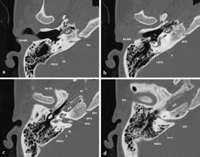 Imaging of inner ear malformations: a primer for radiologists | La  radiologia medica