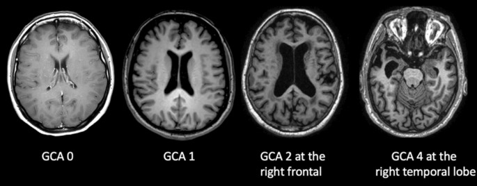 Radiological assessment of dementia: the Italian inter-society 