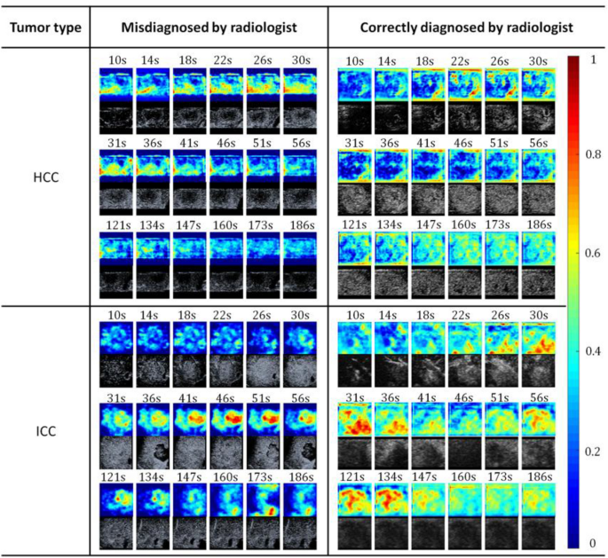 Deep learning model integrating contrast-enhanced ultrasound ...