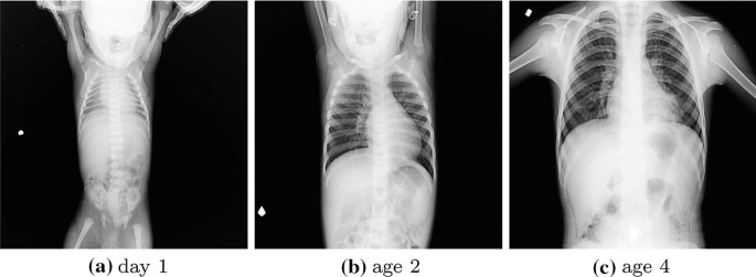 A Review On Lung Boundary Detection In Chest X Rays Springerlink