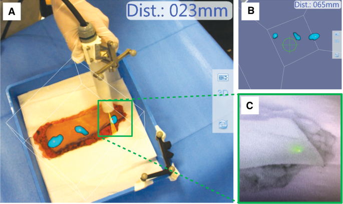 Advancing intraoperative magnetic tracing using 3D freehand magnetic  particle imaging | SpringerLink