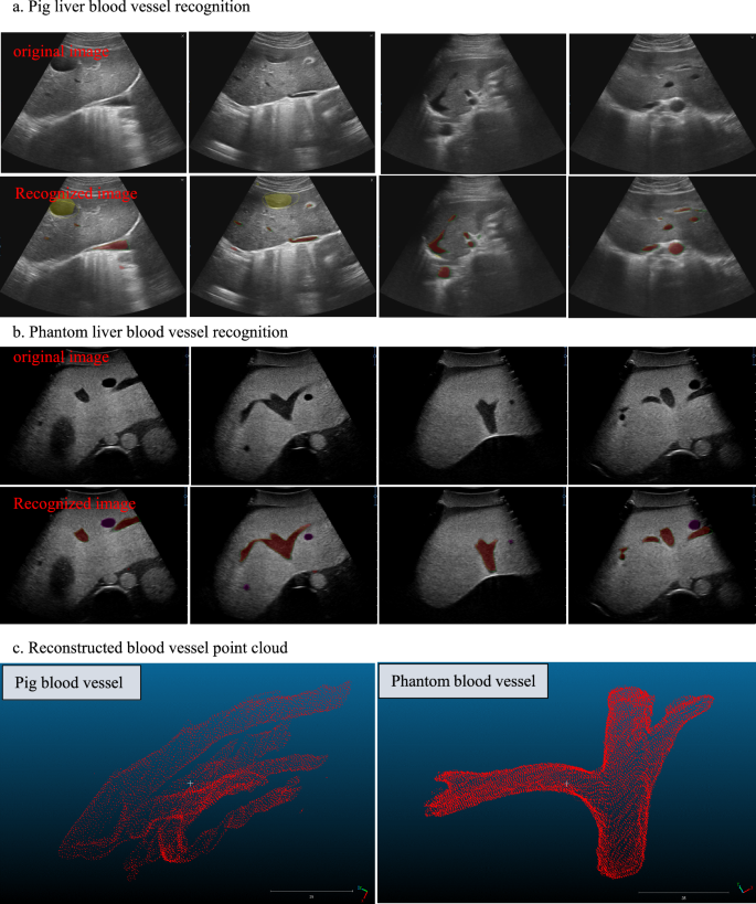 Semiautomatic robotic puncture system based on deformable soft tissue