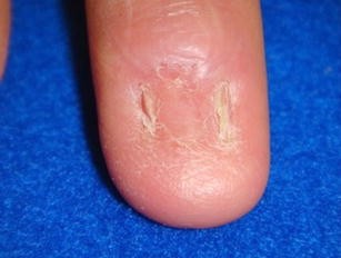 whitlow melanotic Search Results: Thumb, Rash or multiple lesions, 50-59 year old Female whitlow melanotic Management of Nail