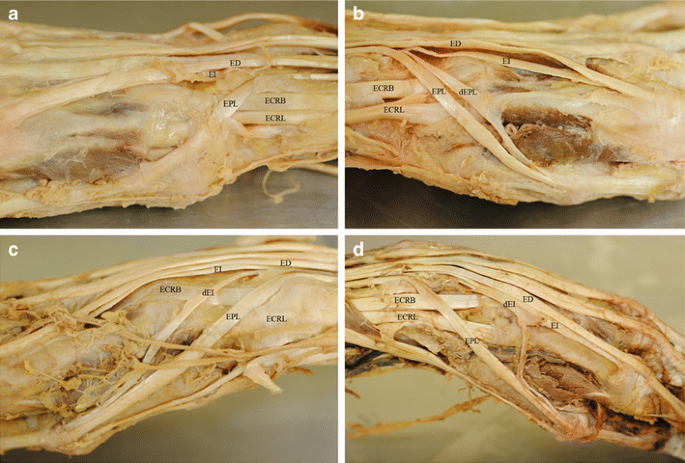 Anomalies Of The Extensor Pollicis Longus And Extensor Indicis Muscles In Two Cadaveric Cases Springerlink
