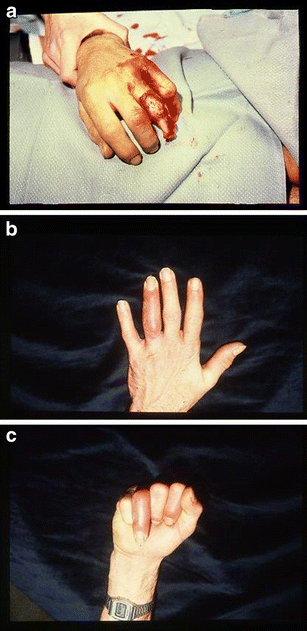 OrthoDx: Finger Injury in 17-Year-Old Patient - Clinical Advisor