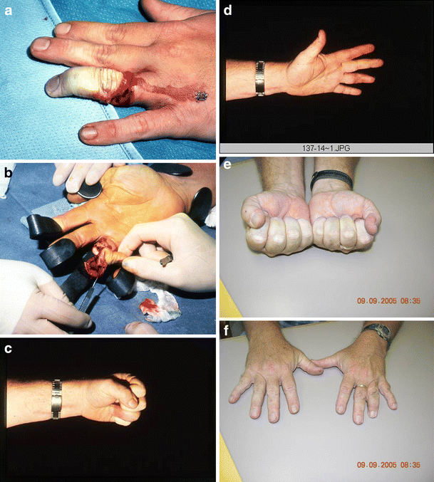 Ring injuries of the finger: long-term follow-up | SpringerLink