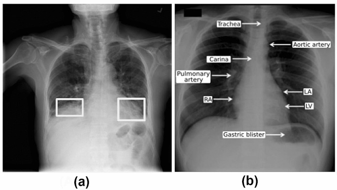 chest x ray pneumonia