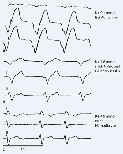 Hyperkaliamie Ein Nephrologischer Notfall Springerlink