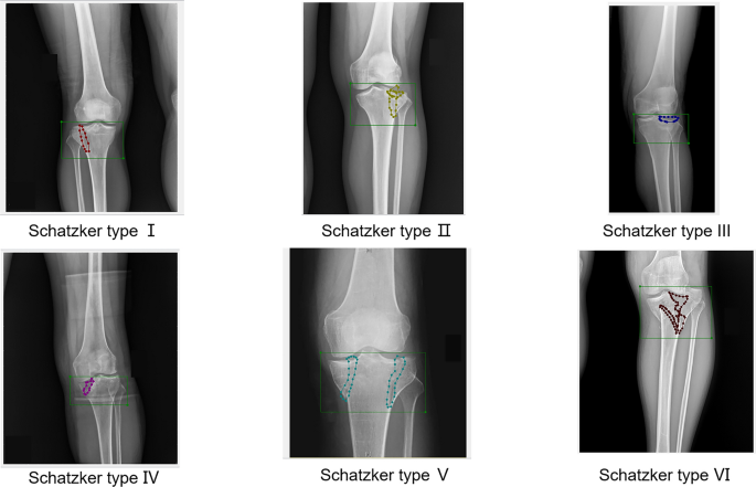 Dual-Stream Attention-Based Classification Network for Tibial Plateau ...