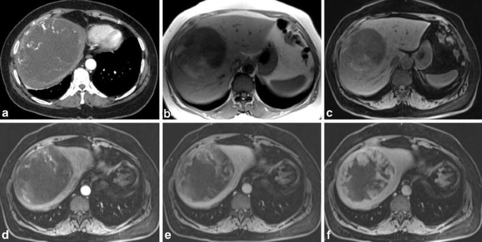 An Unusual Liver Mass Primary Malignant Mesothelioma Of The Liver Springerlink
