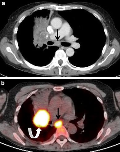 Present and future roles of FDG-PET/CT imaging in the management of cancer | SpringerLink