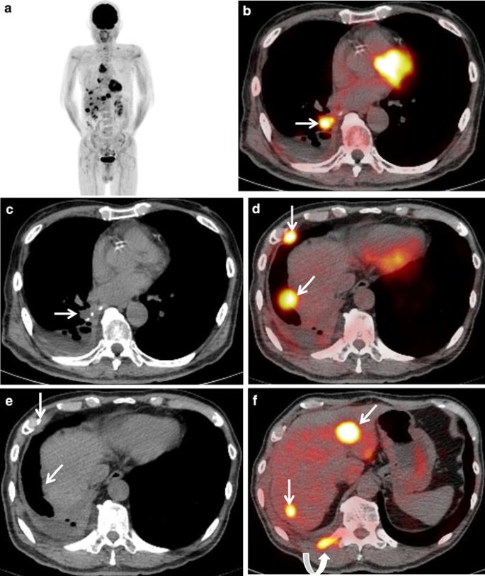 Present and future roles of FDG-PET/CT imaging in the management of lung  cancer | SpringerLink