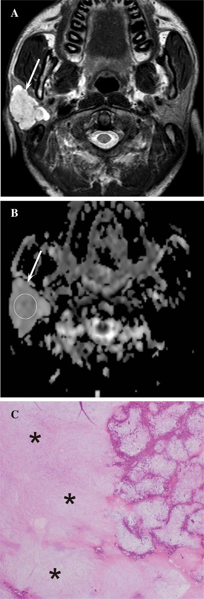 pleomorphic adenoma radiology