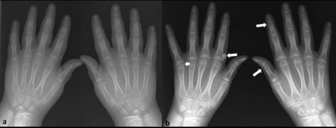 Imaging findings of mixed connective tissue disease in children and  adolescents: a case series | SpringerLink
