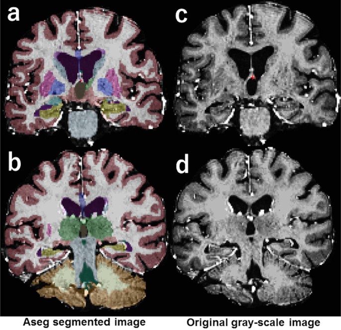 Early Volume Reduction Of The Hippocampus After Whole Brain Radiation Therapy An Automated Brain Structure Segmentation Study Springerlink