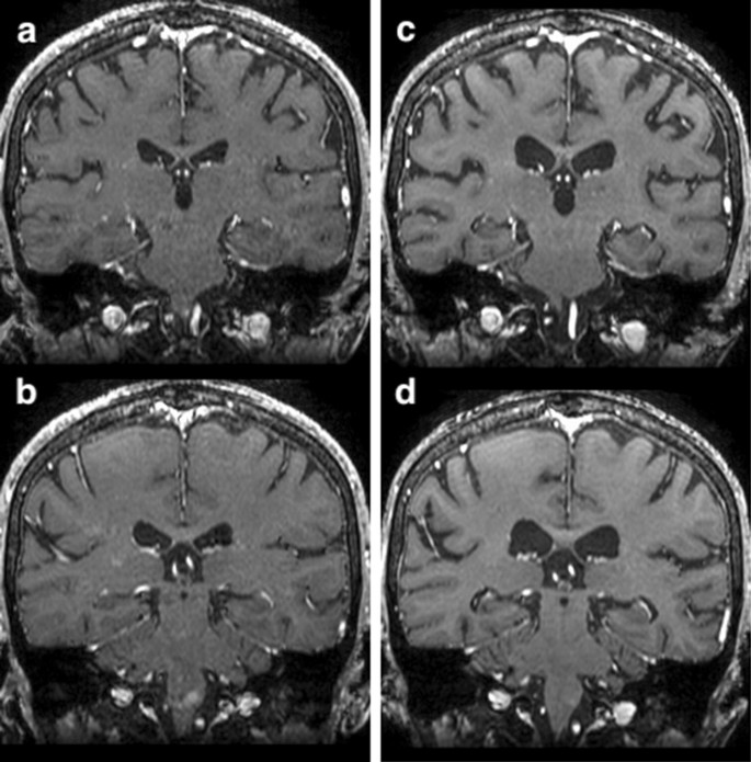 Early Volume Reduction Of The Hippocampus After Whole Brain Radiation Therapy An Automated Brain Structure Segmentation Study Springerlink