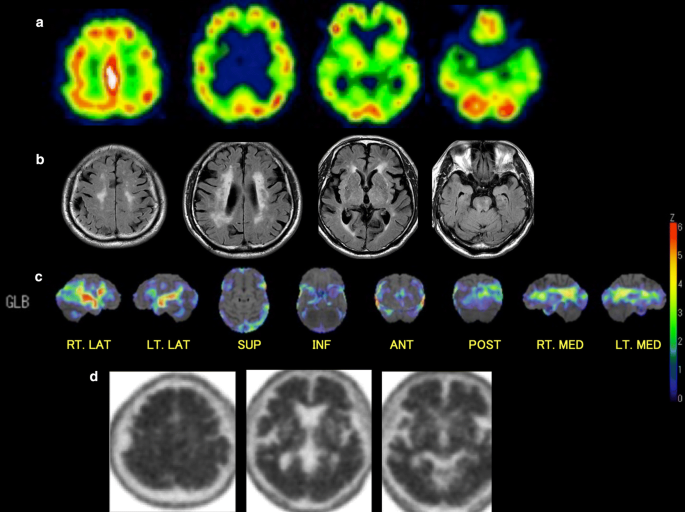 PET and SPECT imaging of the brain: a review on the current status of  nuclear medicine in Japan | SpringerLink
