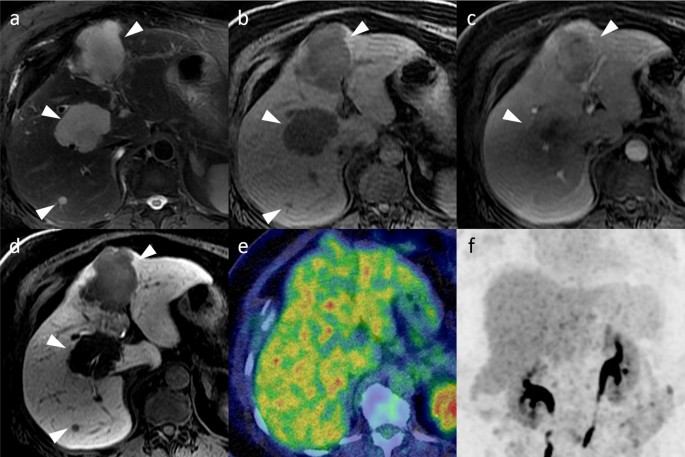 FDG-PET/CT imaging findings of hepatic tumors and tumor-like lesions based on molecular background | SpringerLink FDG-PET/CT imaging findings of hepatic tumors and tumor-like lesions based on molecular background | SpringerLink