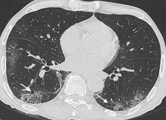 Chest computed tomography findings of COVID-19 pneumonia: pictorial essay with literature SpringerLink