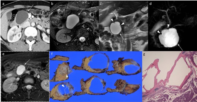 Pearls And Pitfalls Of Imaging Features Of Pancreatic Cystic Lesions A Case Based Approach With Imaging Pathologic Correlation Springerlink