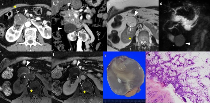 Pearls And Pitfalls Of Imaging Features Of Pancreatic Cystic Lesions A Case Based Approach With Imaging Pathologic Correlation Springerlink