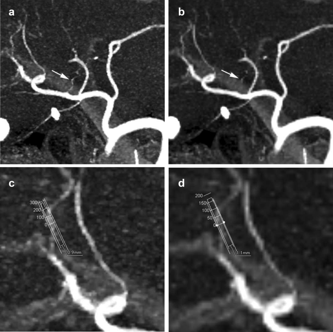 Visualization of small visceral arteries on abdominal CT angiography using  ultra-high-resolution CT scanner | SpringerLink