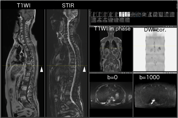 Whole-body MRI: detecting bone metastases from prostate cancer 