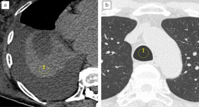 A modified method of lung tissue volume measurement using computed ...