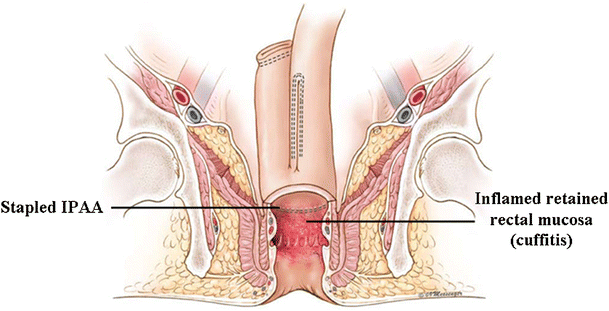 Completion Mucosectomy for Retained Rectal Mucosa Following Restorative  Proctocolectomy with Double-Stapled Ileal Pouch–Anal Anastomosis | Journal  of Gastrointestinal Surgery