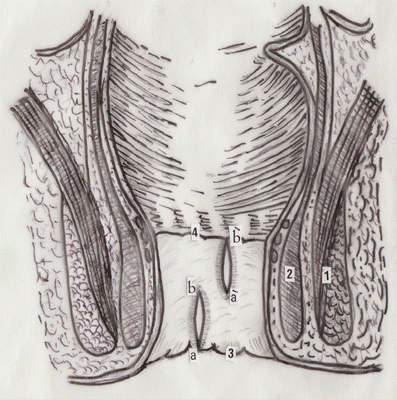 Segmental Internal Sphincterotomy—A New Technique for Treatment of Chronic Anal Fissure | SpringerLink Segmental Internal Sphincterotomy—A New Technique for Treatment of Chronic Anal Fissure | SpringerLink