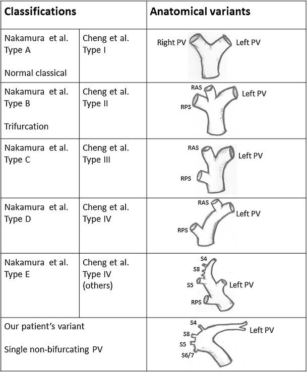 Extended Right Hepatectomy In A Liver With A Non Bifurcating Portal Vein The Hanging Maneuver Protects The Portal System In The Presence Of Anomalies Springerlink