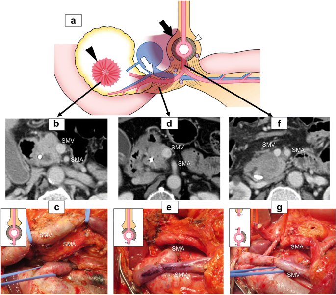 Optimal Extent of Superior Mesenteric Artery Dissection during  Pancreaticoduodenectomy for Pancreatic Cancer: Balancing Surgical and  Oncological Safety | SpringerLink