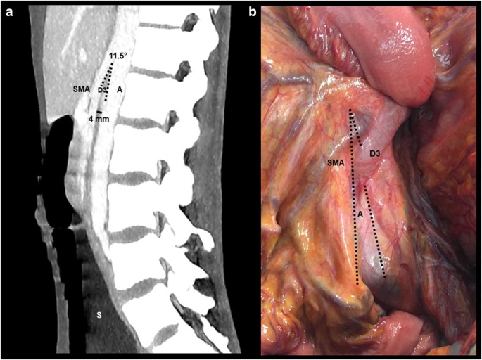 Superior Mesenteric Artery Syndrome Aggravating Severe Malnutrition Springerlink Superior Mesenteric Artery Syndrome Aggravating Severe Malnutrition Springerlink