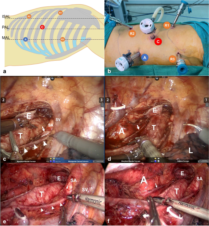 Robot-Assisted Versus Thoraco-laparoscopic McKeown Esophagectomy for  Esophageal Cancer: a Propensity Score-Matched Study | SpringerLink