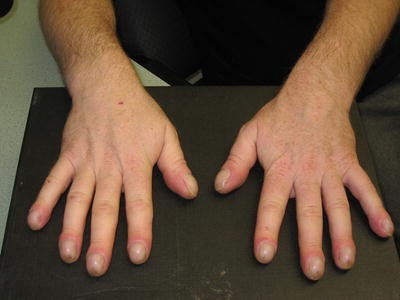 Clinical Image Clubbed With A Reminder To Test For Hiv Springerlink Clinical Image Clubbed With A Reminder To Test For Hiv Springerlink