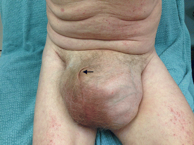 scaphoid abdomen picture
