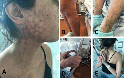 Træts webspindel boks bifald Vascular Ehlers-Danlos Syndrome Presenting as a Pulsatile Neck Mass: a Case Report and Review of Literature | SpringerLink Træts webspindel boks bifald Vascular Ehlers-Danlos Syndrome Presenting as a Pulsatile Neck Mass: a Case Report and Review of Literature | SpringerLink