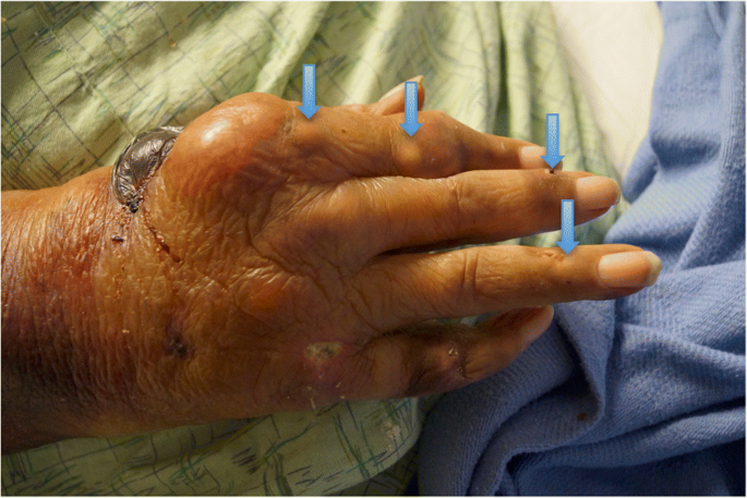 Gout In Extremis Massive Soft Tissue Tophaceous Deposits Springerlink