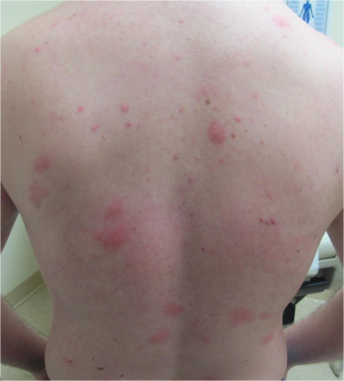 Chickenpox in a Vaccinated Adult | SpringerLink