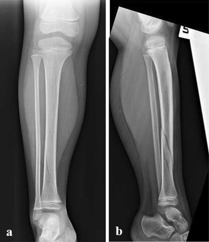 Le fratture di gamba in età pediatrica | SpringerLink