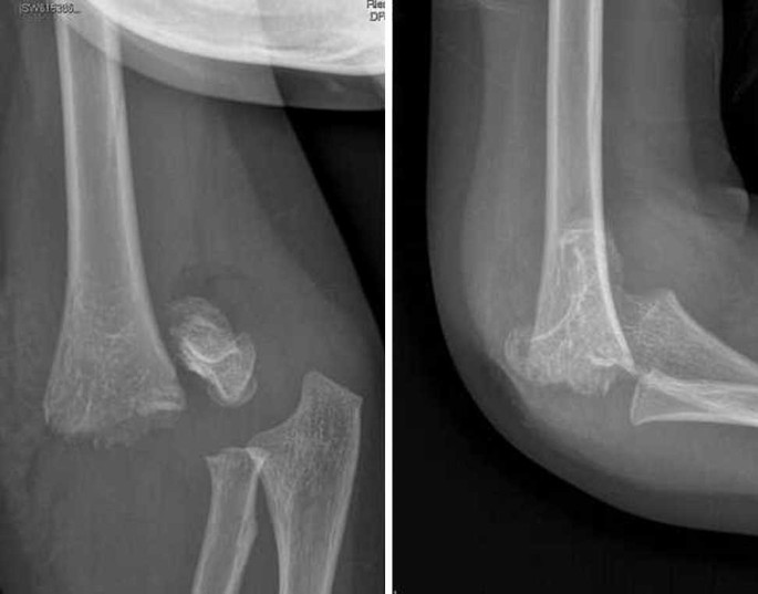 Le Fratture Sovracondiloidee Dell Omero In Eta Pediatrica Springerlink