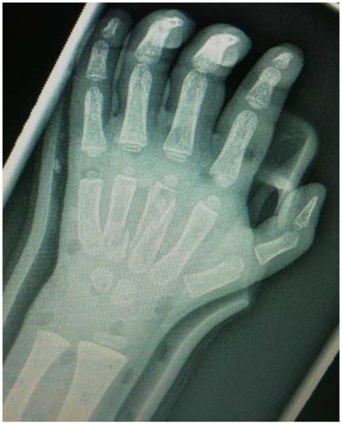Le fratture della mano in età pediatrica | SpringerLink
