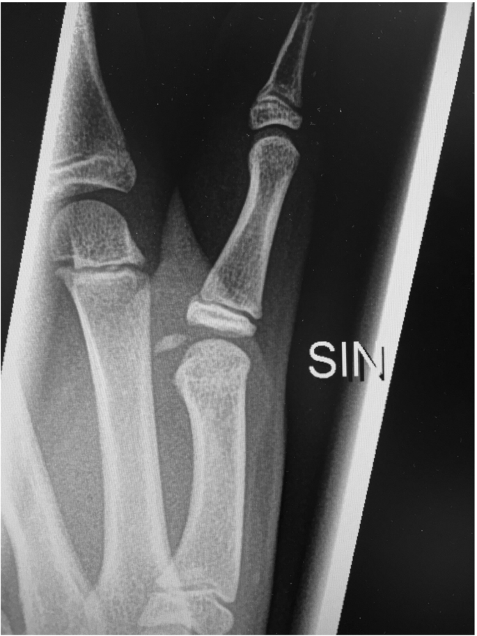 Le fratture della mano in età pediatrica | SpringerLink