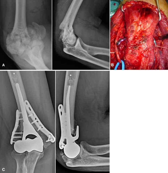 Fratture dell'omero distale: trattamento con protesi di gomito |  SpringerLink