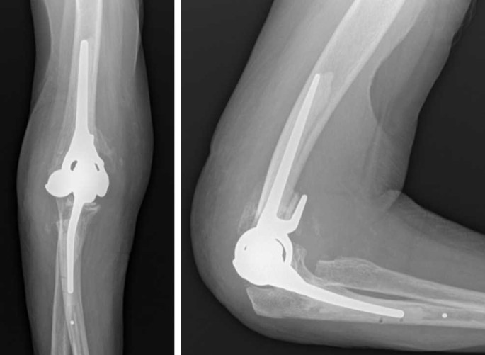 Le protesi di gomito: considerazioni cliniche e metodologiche | SpringerLink