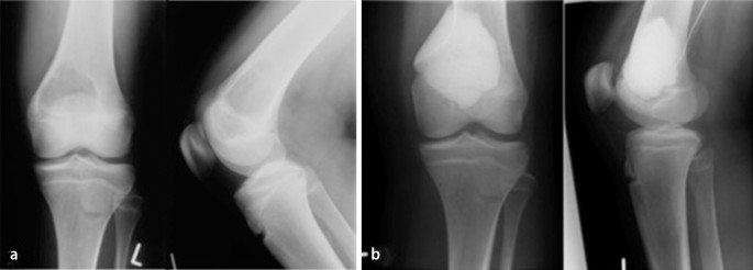 Neue Therapieansatze Beim Riesenzelltumor Springerlink