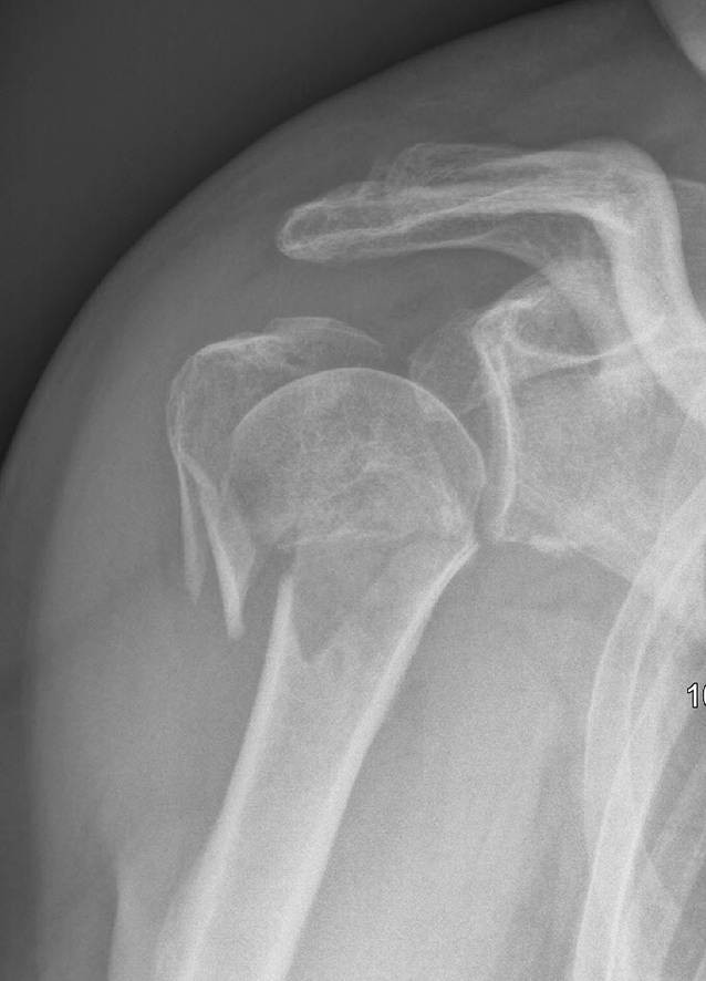 Head Split Fractures Of The Proximal Humerus Springerlink