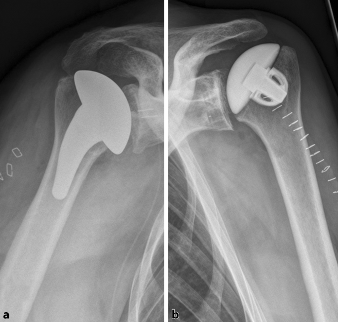 Stem length in anatomic total shoulder arthroplasty: long stem, short stem,  and stemless | SpringerLink