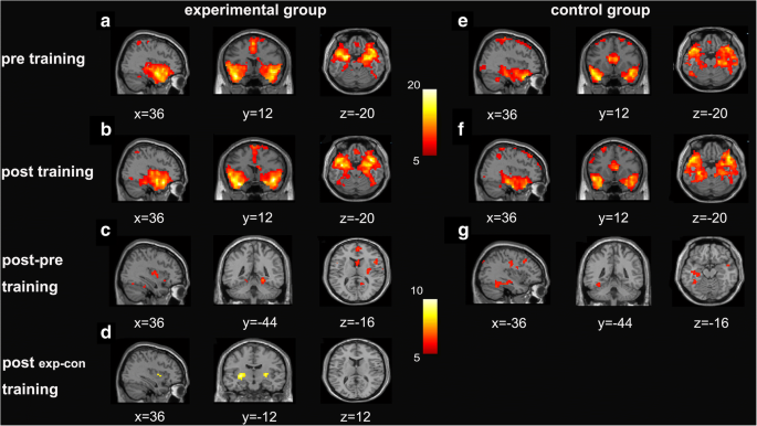 Amygdala Network In Response To Facial Expression Following Neurofeedback Training Of Emotion Springerlink